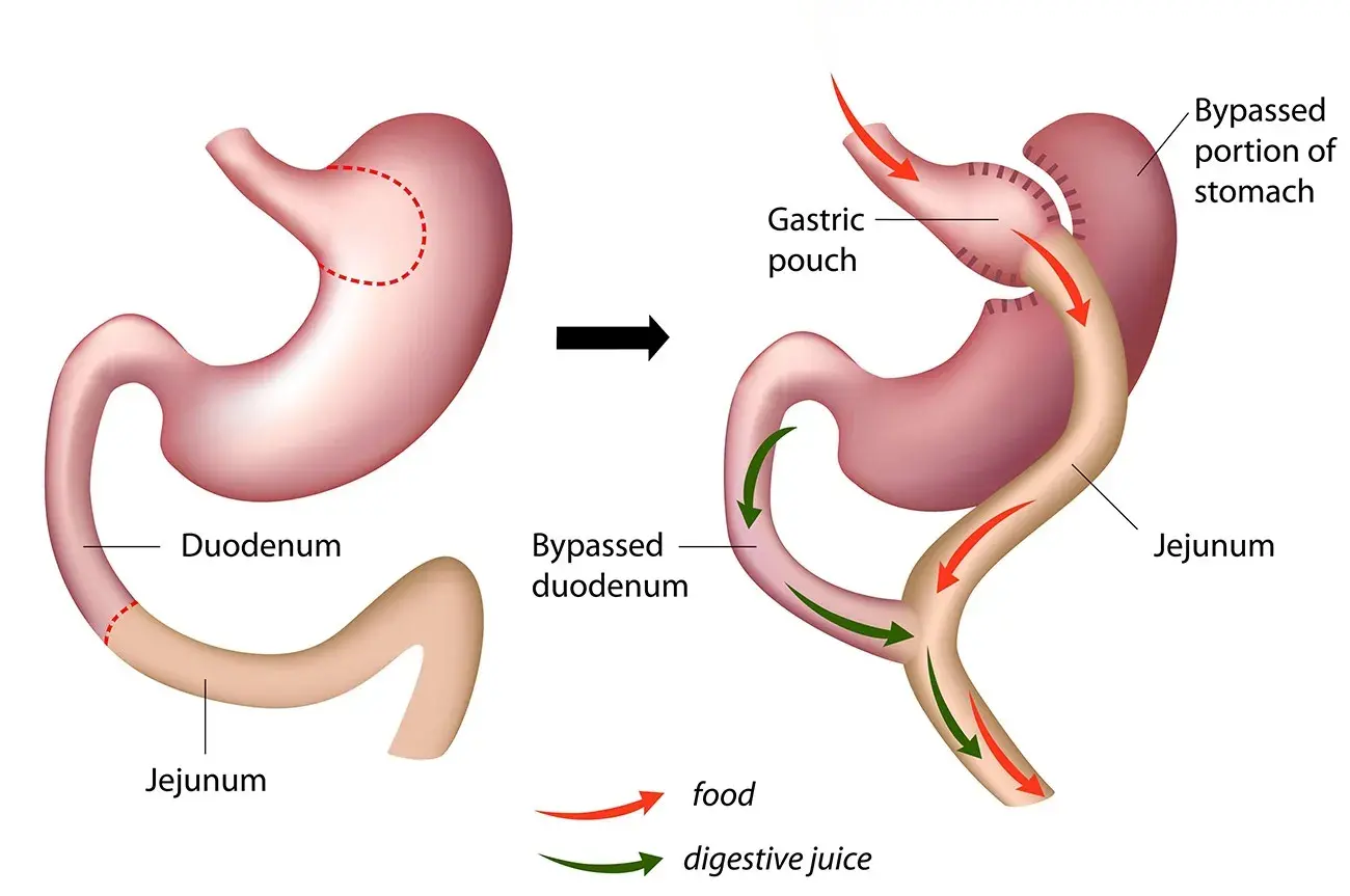 Gastric Bypass